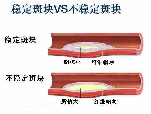 这些斑块凸向血管腔使血管腔变得狭窄.