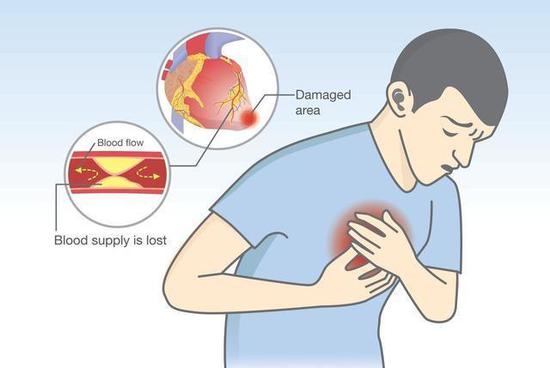 6,心肌梗死最先出现的症状心跳加剧